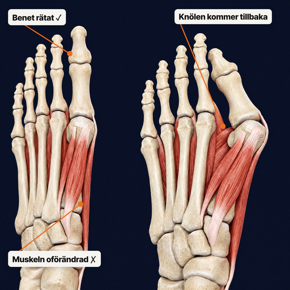 Stryde Bunion EMS, hallux valgus-korrigerare med muskelstimulering